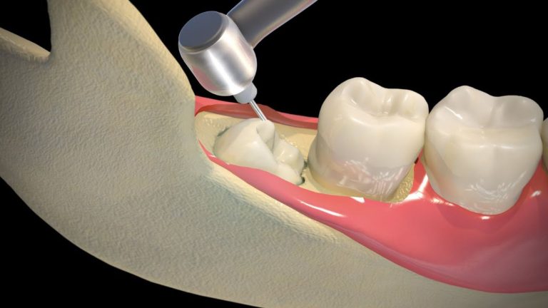 Wisdom Tooth Removal Painful